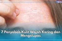Penyebab Dan Solusi Kulit Kering Parah yang Perlu Diketahui